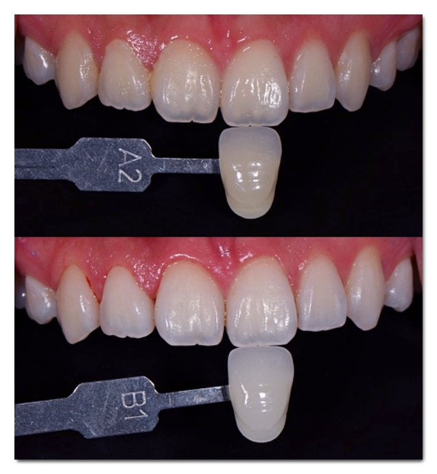 How to Whiten Yellow Teeth? Teeth Whitening vs. Veneers image 5