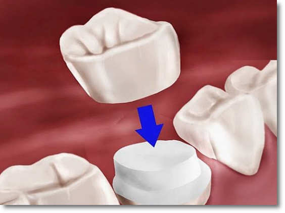 A Complete Guide to the Differences Between All-Ceramic, Zirconia, and PFM Dental Crowns image 3