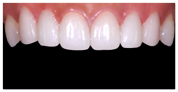 Which Is Better for Crowded Teeth: Veneers or Orthodontic Treatment? image 6