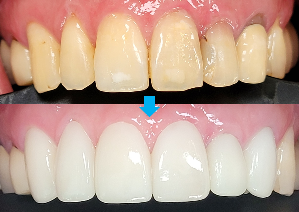 Improving Yellowed Front Teeth with Laminates: When Gum Treatment Is Needed Before Laminates image 9