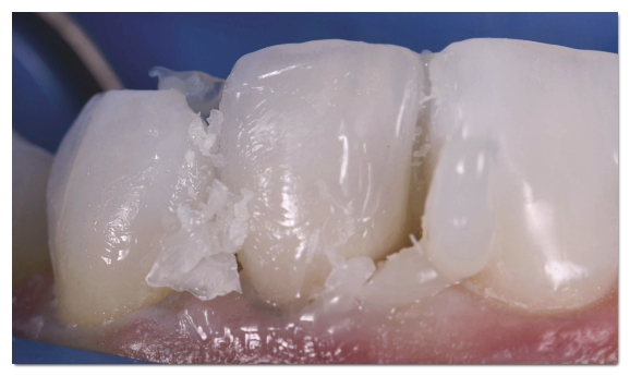 Why the Amount of Tooth Reduction for Veneers Determines Your Oral Health for Life image 9