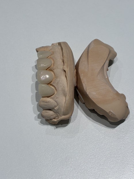 양재역 라미네이트, 과하지 않게 앞니 개선 가능한가요? 관련 이미지 6