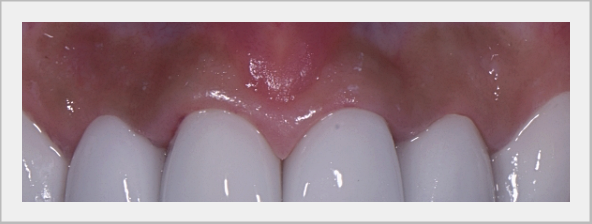 What to Look for When Choosing a Laminate Veneer Clinic image 6