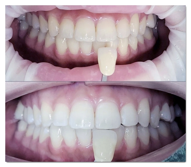 Why Teeth Turn Yellow and 4 Proper Ways to Address It image 5