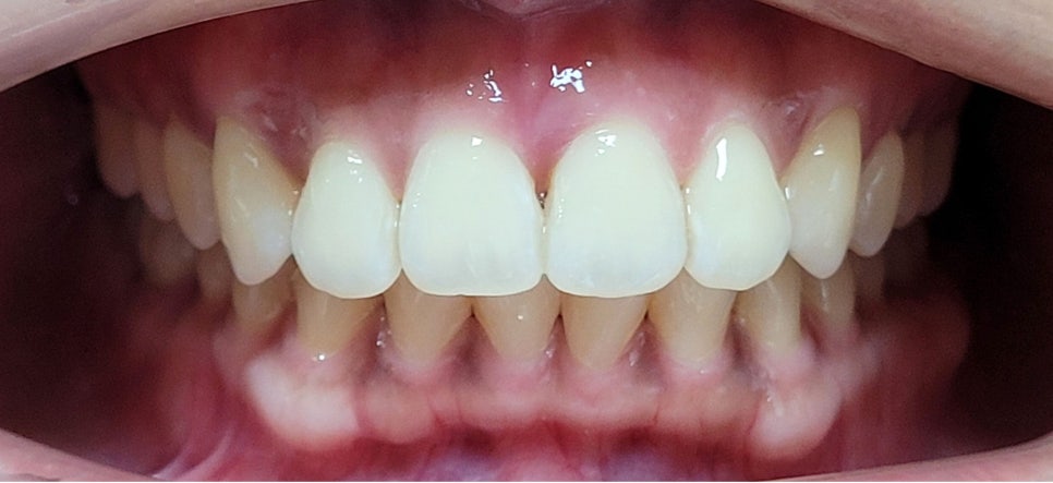 강남원진치과, 앞니부분교정 &lsquo;이 기준&rsquo; 확인하세요 관련 이미지 10