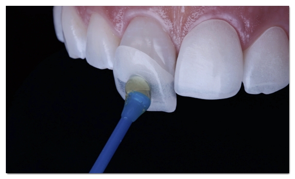 Why Teeth Turn Yellow and 4 Proper Ways to Address It image 7
