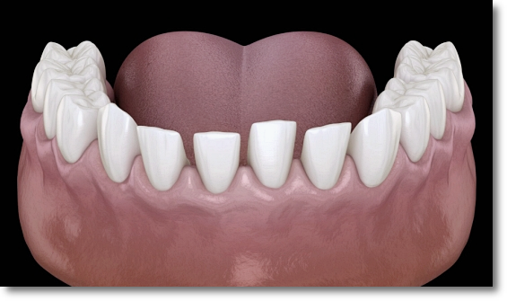Can No-Prep Veneers Be Used on Every Tooth? image 4
