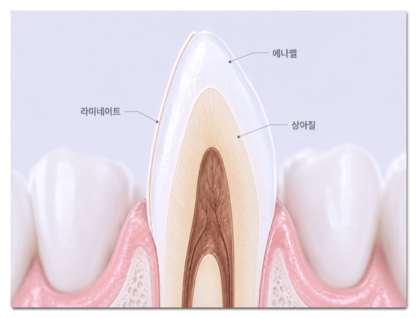 라미네이트 입냄새 왜 생길까? 원인 5가지와 해결법 총정리 관련 이미지 8