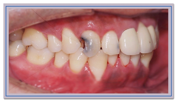 One-Day Teeth Whitening? How to Brighten Your Front Teeth in Just One Day image 6