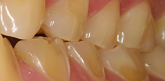 역삼동치아미백, 시작 전 이 2가지는 꼭 확인하세요 (의사작성) 관련 이미지 5