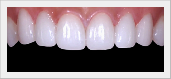 What to Look for When Choosing a Laminate Veneer Clinic image 3