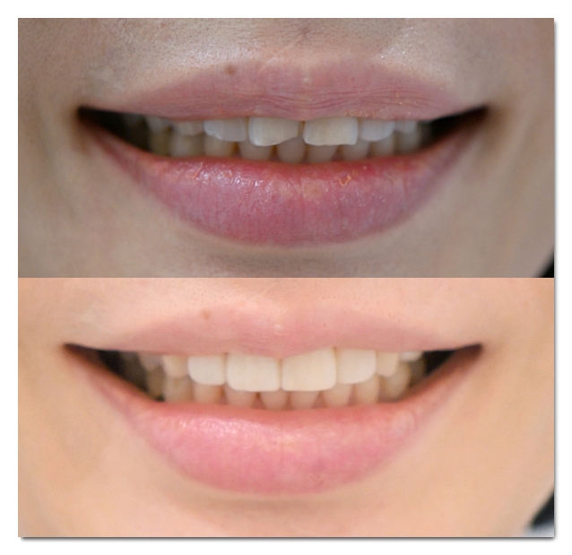 Dental Veneers for Front Teeth: When Are They a Good Option? image 3