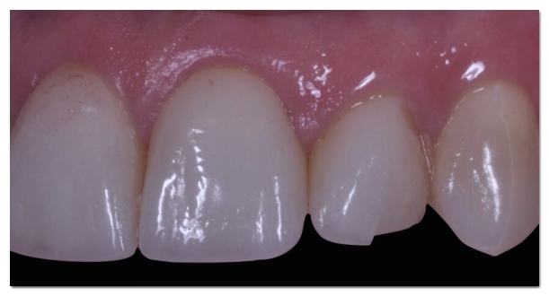 What to Do When a Laminate Veneer Breaks and the Treatment Approach image 3