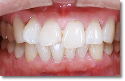 Can No-Prep Veneers Be Used on Every Tooth? image 5
