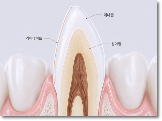 Can No-Prep Veneers Be Used on Every Tooth? image 3