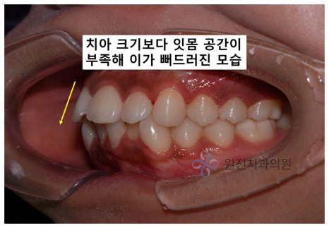 비발치교정, 나도 치아를 안 뽑고 할 수 있을까? 관련 이미지 4