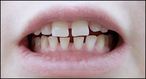 Laminates or Orthodontics: How to Choose for Gapped Front Teeth? image 2