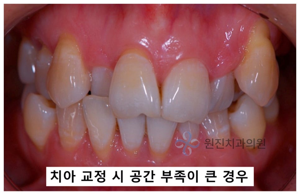 비발치교정, 나도 치아를 안 뽑고 할 수 있을까? 관련 이미지 2