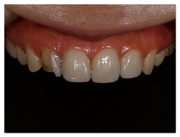 When Your Front Tooth Is Cracked, Do You Need to Visit the Dentist Immediately? (What to Check Before It Breaks) image 11