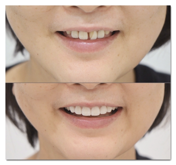 Can Malocclusion Be Treated with Veneers Without Orthodontics? image 9