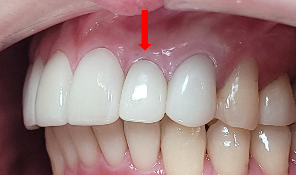 Improving Yellowed Front Teeth with Laminates: When Gum Treatment Is Needed Before Laminates image 4