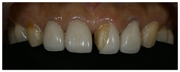 How Many Veneers Should You Get? Criteria for Making Your Choice image 9