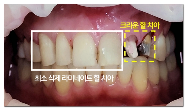 Celebrity Veneers: How Are They Different from Regular Veneers? image 5