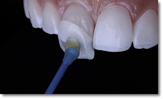 Precautions to Know Before Undergoing Gum Contouring image 6