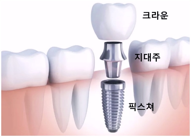 What Matters More Than Implant Prices image 3