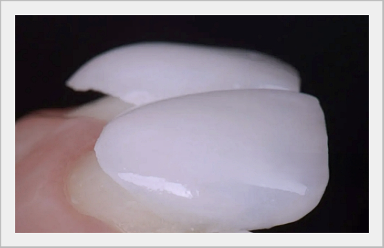 What to Look for When Choosing a Laminate Veneer Clinic image 5