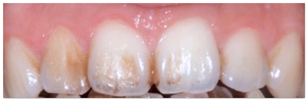 A Complete Guide to the Causes of Front Tooth Resin Discoloration and Solutions by Type image 5