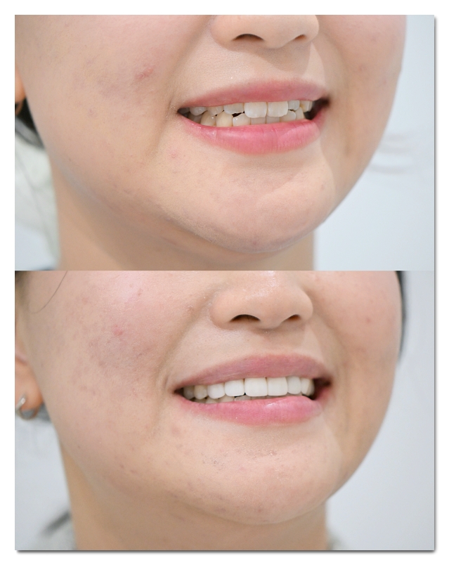 Which Is Better for Crowded Teeth: Veneers or Orthodontic Treatment? image 12