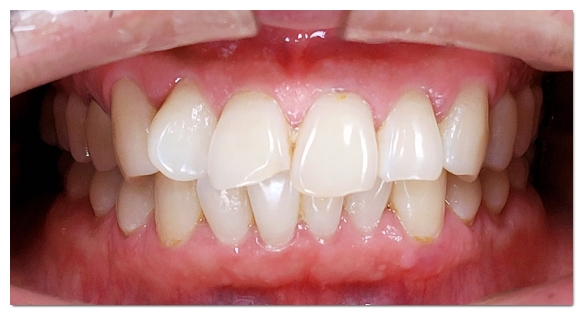 Swollen Gums: A Complete Guide to the Causes and Signs You Should Visit the Dentist image 3
