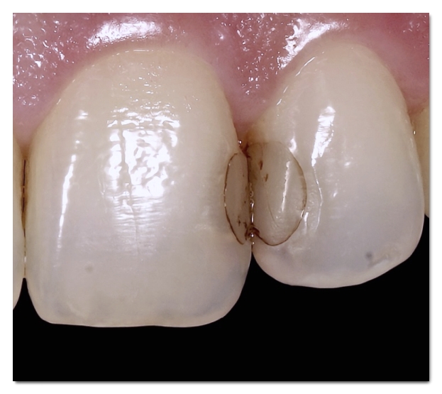 A Complete Guide to the Causes of Front Tooth Resin Discoloration and Solutions by Type image 4