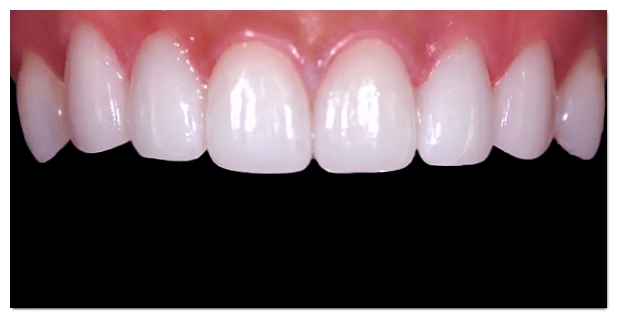 How to Choose a Good Laminate Dental Clinic Near Gangnam Station image 5