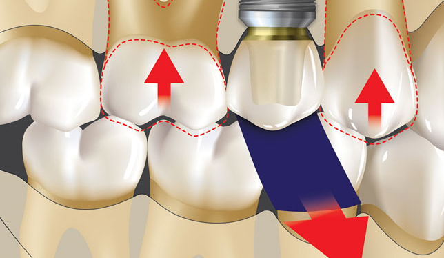 역삼동 앞니 임플란트 교체 신호 3가지 (의사작성) 관련 이미지 13