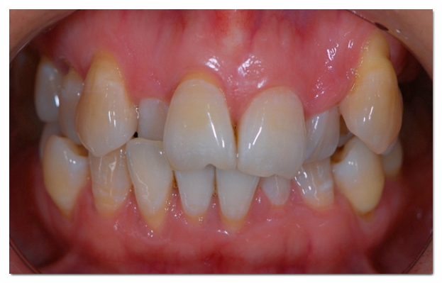 Which Is Better for Crowded Teeth: Veneers or Orthodontic Treatment? image 2
