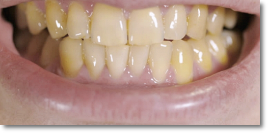 Gangnam One-Day Teeth Whitening Treatment Process and Duration image 2