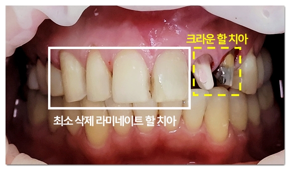 Why the Amount of Tooth Reduction for Veneers Determines Your Oral Health for Life image 5