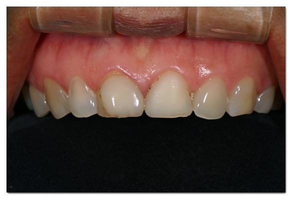 How Many Veneers Should You Get? Criteria for Making Your Choice image 3
