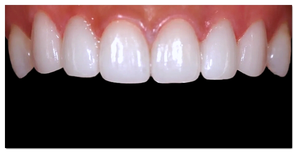 Front Teeth Laminate Veneer Prices: Why the Difference Between KRW 200,000 and KRW 1,000,000? How to Choose What’s Right for You image 8