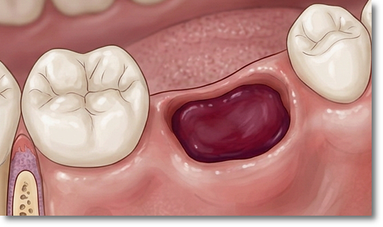 Post-Wisdom Tooth Extraction Precautions: When Can You Eat, Brush, and Exercise? image 3