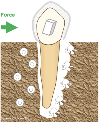 서초동치과, 앞니 사이가 까많게 보여요 <블랙트라이앵글 치료사례> 관련 이미지 7