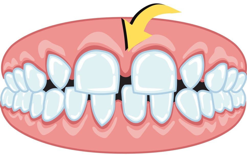 역삼동 앞니벌어짐, 브리네이트 vs 라미네이트 (의사조언) 관련 이미지 3