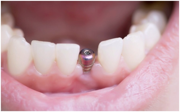 What Matters More Than Implant Prices image 6