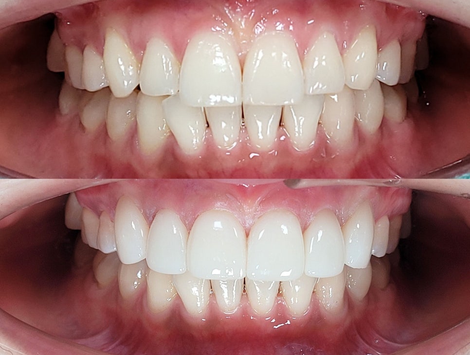 양재역 라미네이트, 과하지 않게 앞니 개선 가능한가요? 관련 이미지 13