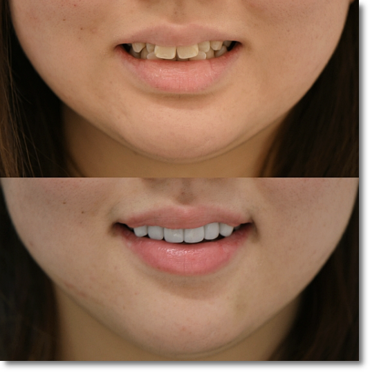 Precautions to Know Before Undergoing Gum Contouring image 5
