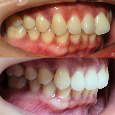 강남원진치과, 앞니부분교정 &lsquo;이 기준&rsquo; 확인하세요 관련 이미지 11