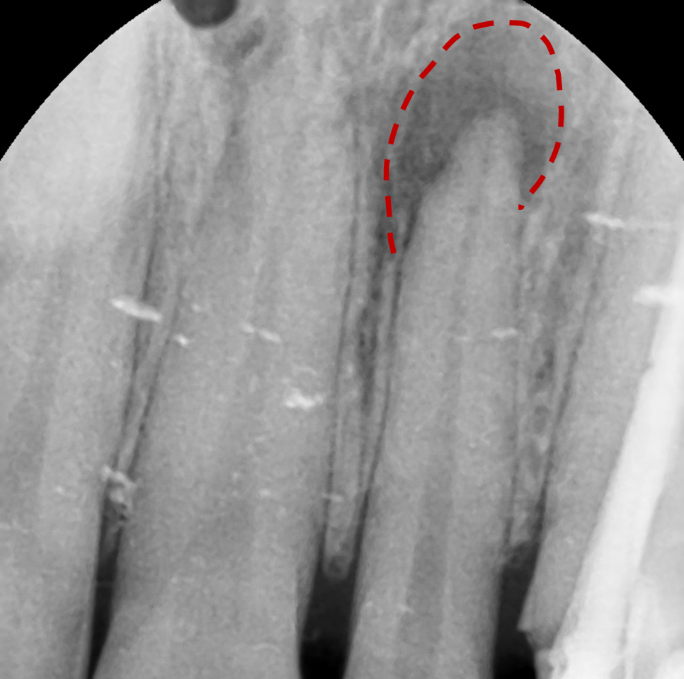Improving Yellowed Front Teeth with Laminates: When Gum Treatment Is Needed Before Laminates image 2