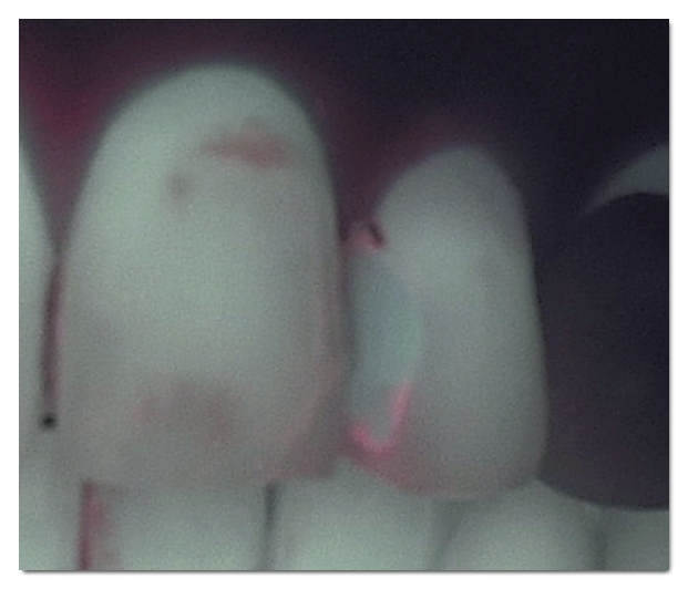A Complete Guide to the Causes of Front Tooth Resin Discoloration and Solutions by Type image 7